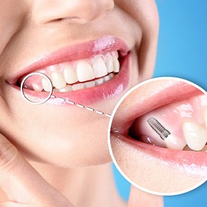 Nose-to-neck view of woman smiling with tooth indicated as implant