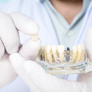 Gloved hands holding model jaw with single sample dental implant and dental crown