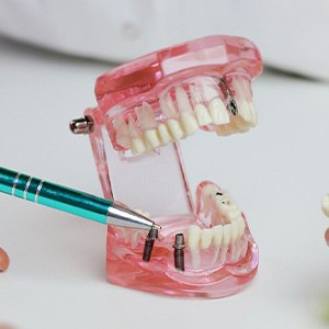 Dentist pointing to model implants with pen holding dental bridge in other hand