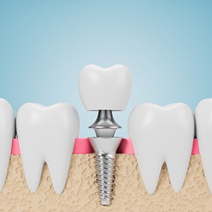 Osseointegration is the process by which your dental implant permanently fuses with your jawbone