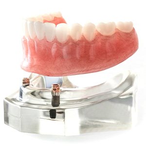 Model jaw with implants anchoring dentures