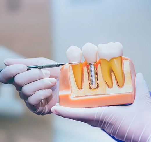 Gloved hands holding a model of a dental implant in Georgetown