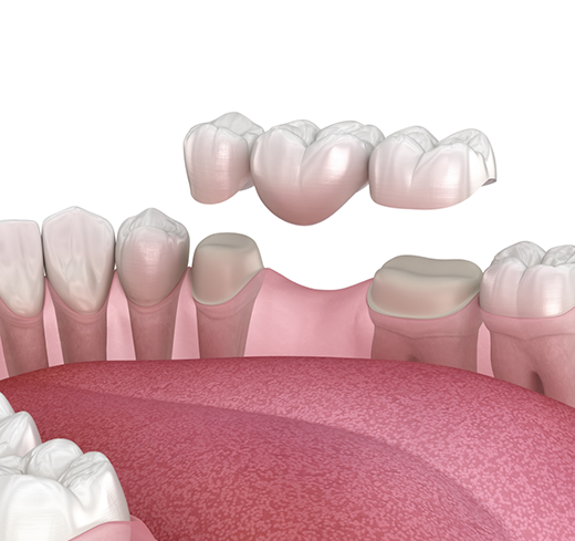 Illustration of dental bridge being attached to natural teeth
