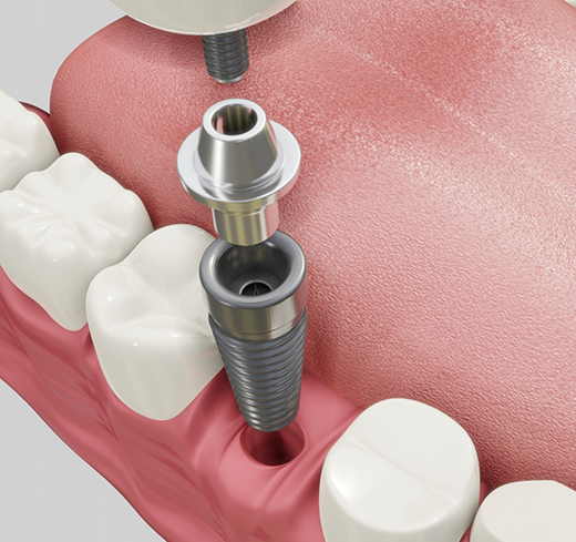 Illustration of dental implant post being placed in lower jaw