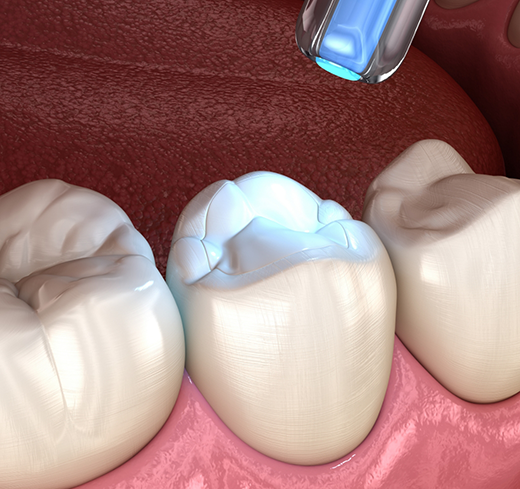 Illustration of filling being hardened in place