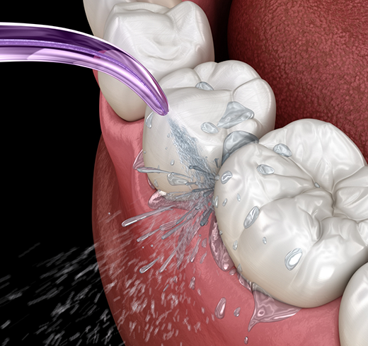 Illustration of teeth being cleaned with water