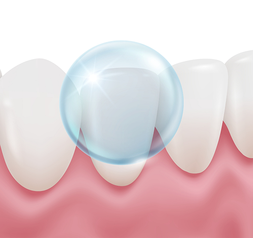 Illustration of fluoride being applied to tooth