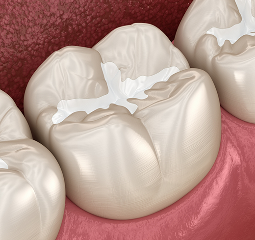 Illustration of teeth with dental sealants