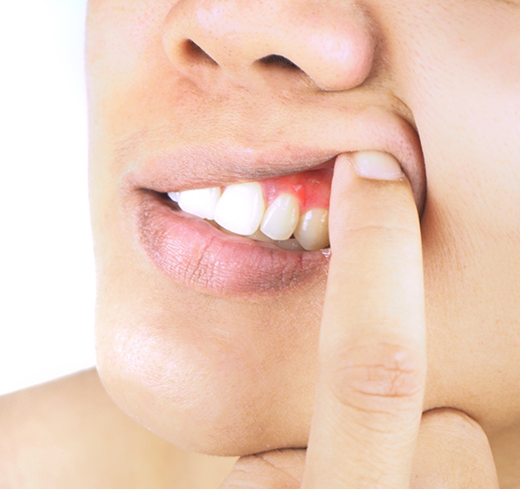 Person pulling up lip to show inflamed gums