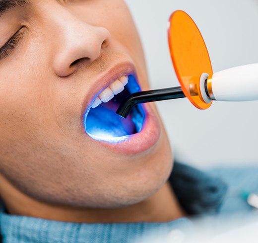 Male patient receiving cosmetic bonding in lower teeth