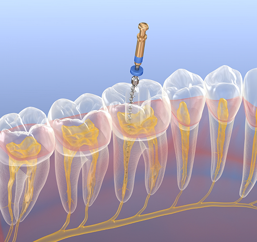 Illustration of root canal treatment being performed on lower teeth