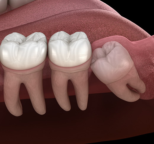 Illustration of an impacted tooth