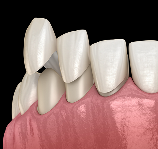 Illustration of veneers being placed on teeth
